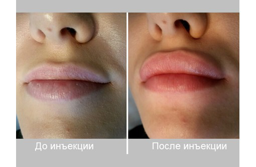 Увеличение губ Контурная пластика! - Косметологические услуги в Севастополе