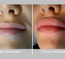 Увеличение губ Контурная пластика! - Косметологические услуги в Севастополе