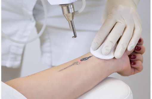 Лазерное удаление татуировок и перманентного татуажа - Косметологические услуги в Севастополе