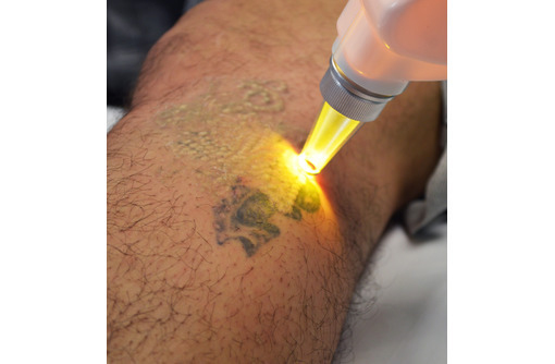 Лазерное удаление татуировок и перманентного татуажа - Косметологические услуги в Севастополе