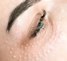 Биоревитализация кожи вокруг глаз - Косметологические услуги в Севастополе